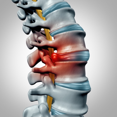 herniated - disc